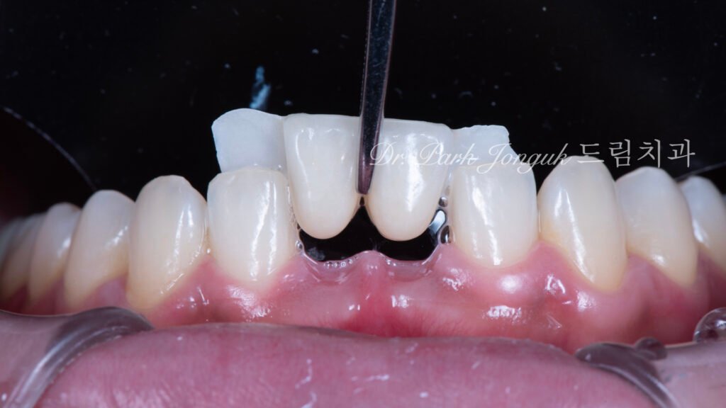 Anterior Maryland Bridge 앞니 메릴랜드 브릿지