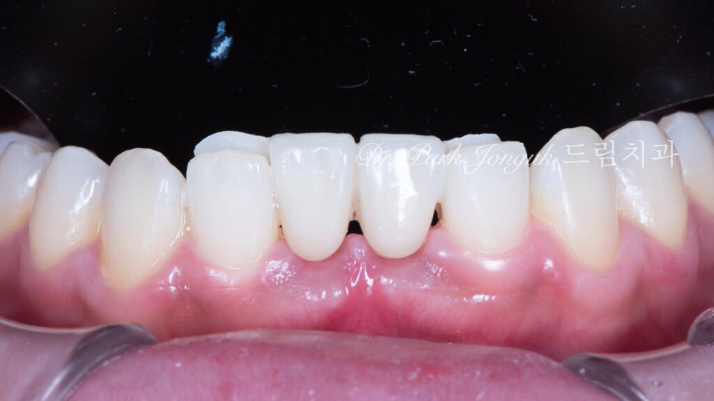 Anterior Maryland Bridge 앞니 메릴랜드 브릿지