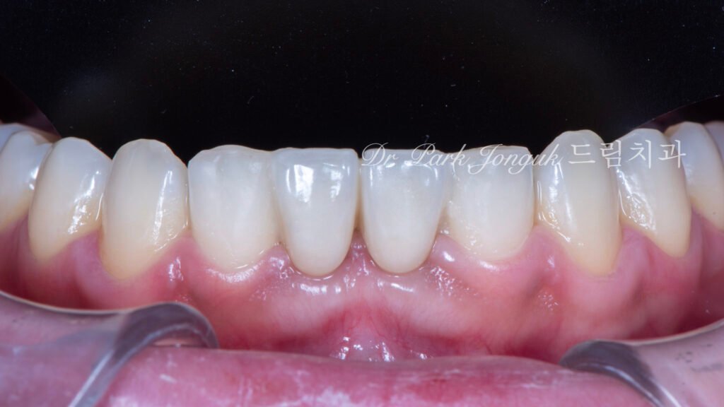 Anterior Maryland Bridge 앞니 메릴랜드 브릿지