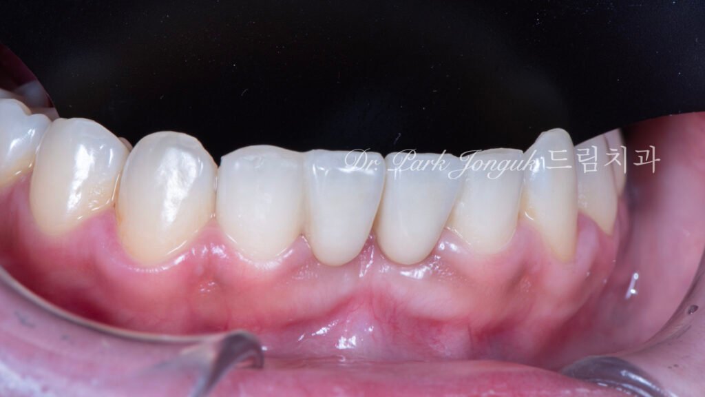 Anterior Maryland Bridge 앞니 메릴랜드 브릿지