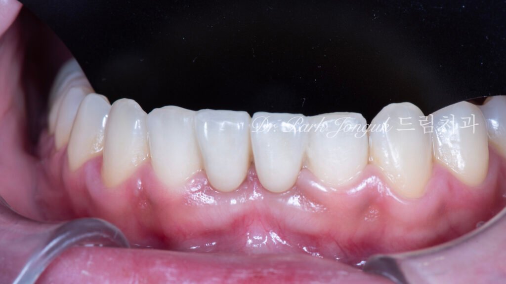 Anterior Maryland Bridge 앞니 메릴랜드 브릿지