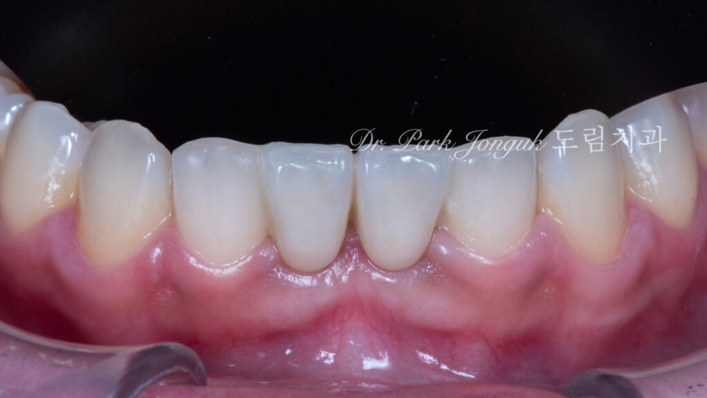 Anterior Maryland Bridge 앞니 메릴랜드 브릿지