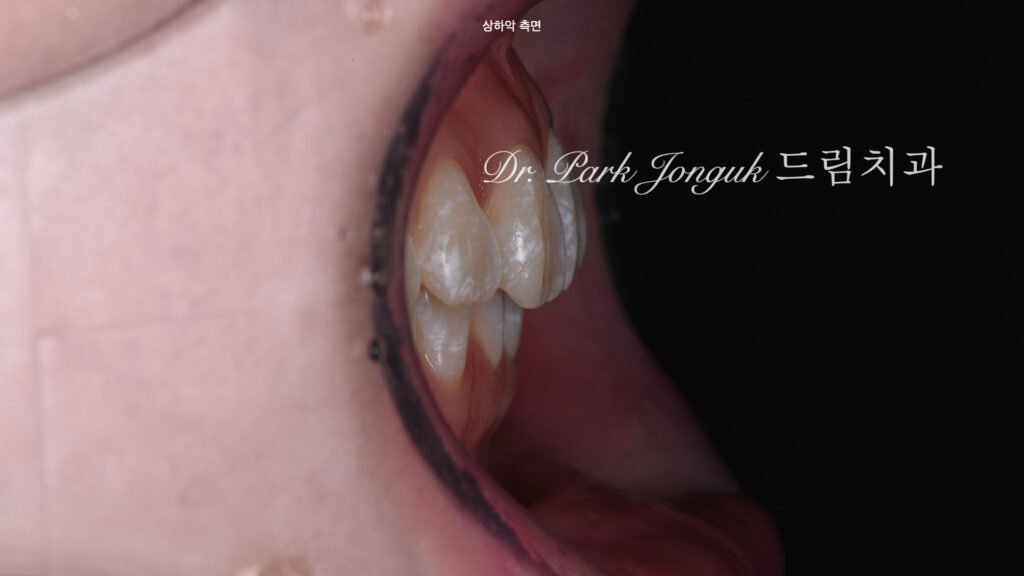 앞니 변색 얼룩 치아 라미네이트 치료