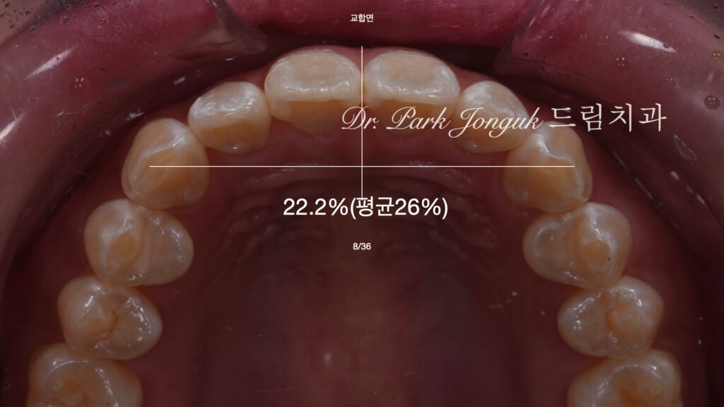 앞니 변색 얼룩 치아 라미네이트 치료