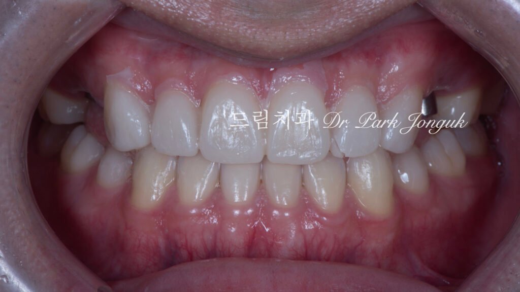 무삭제라미네이트-임시치아-상담