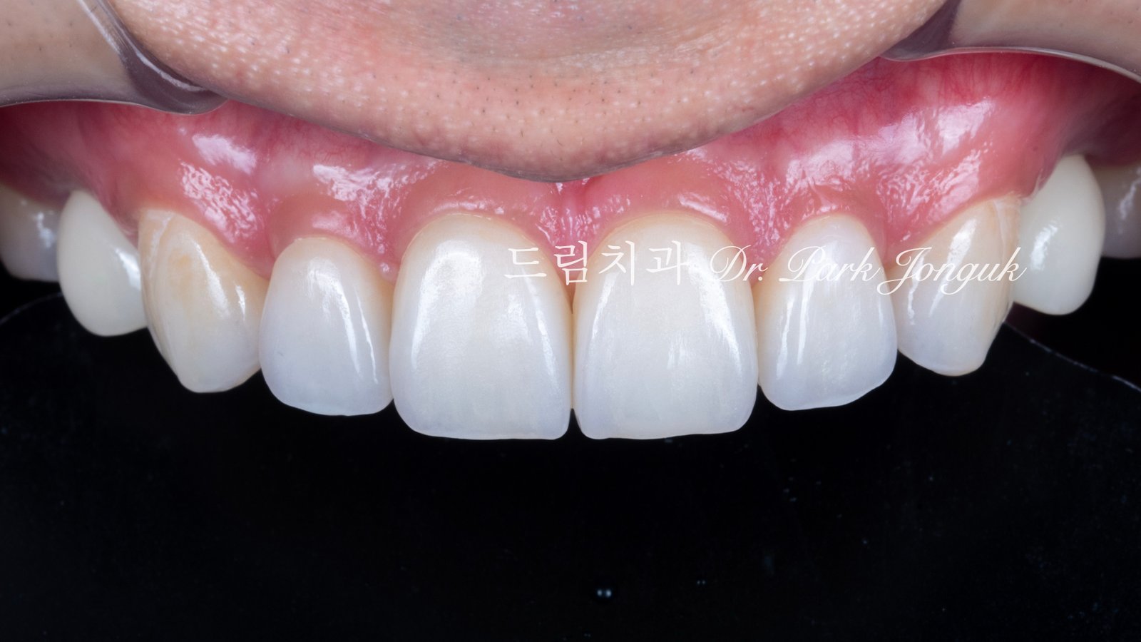 무삭제라미네이트-최종결과