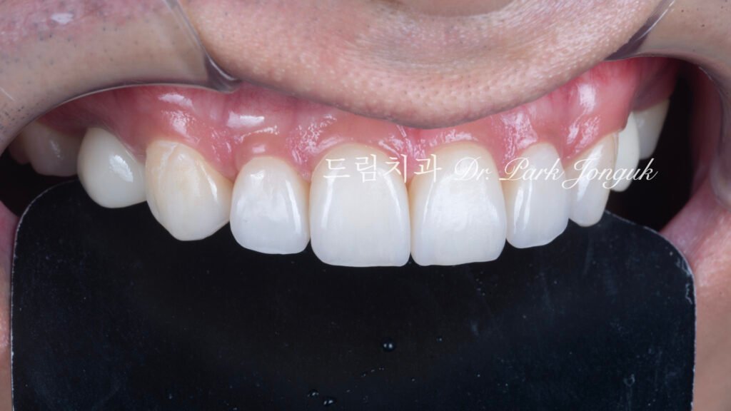 무삭제라미네이트-최종결과