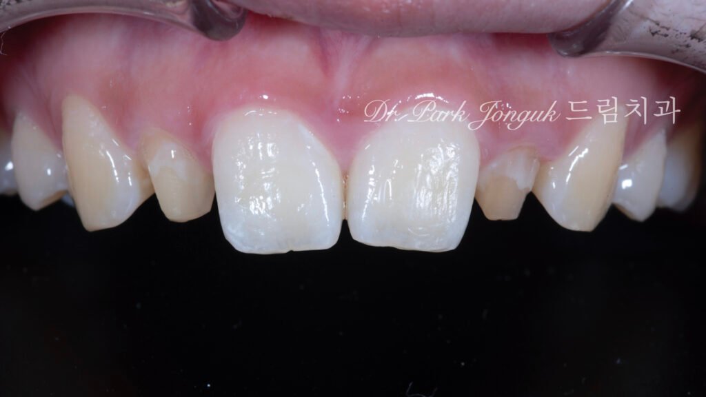 왜소측절치-재치료-초진상태