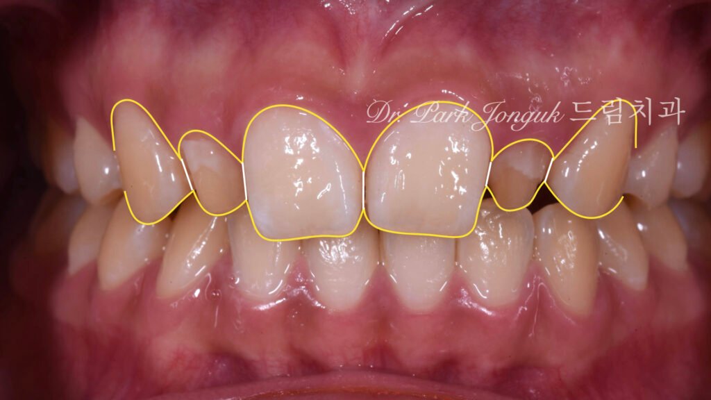 왜소측절치-치료계획-디자인