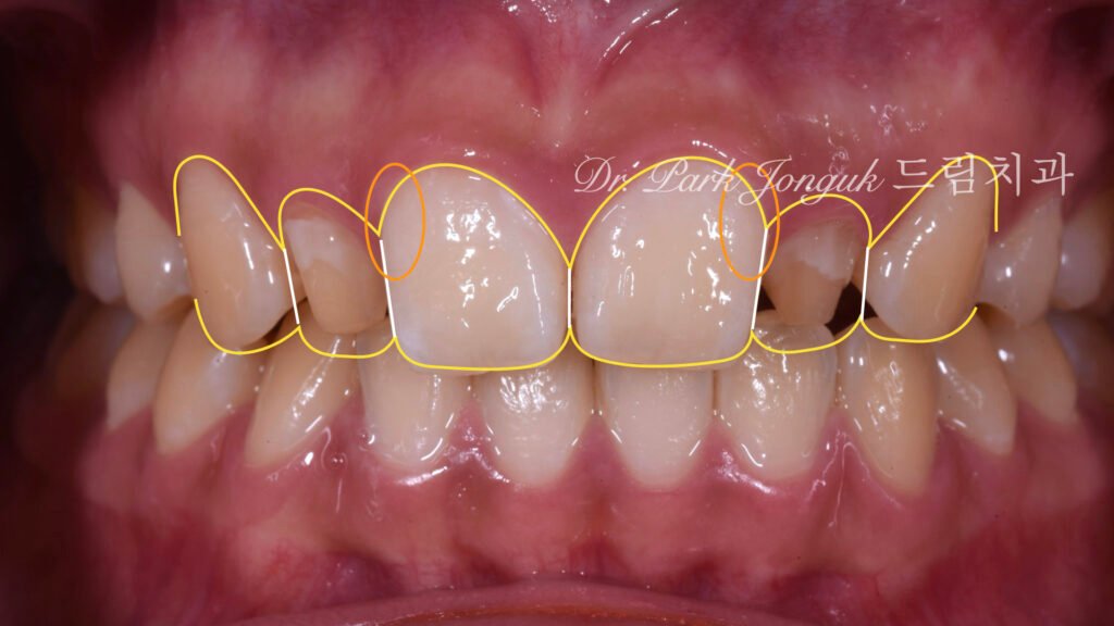 왜소측절치-치료계획-디자인