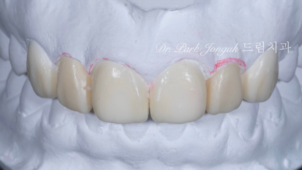 왜소측절치-왁스업-정밀진단