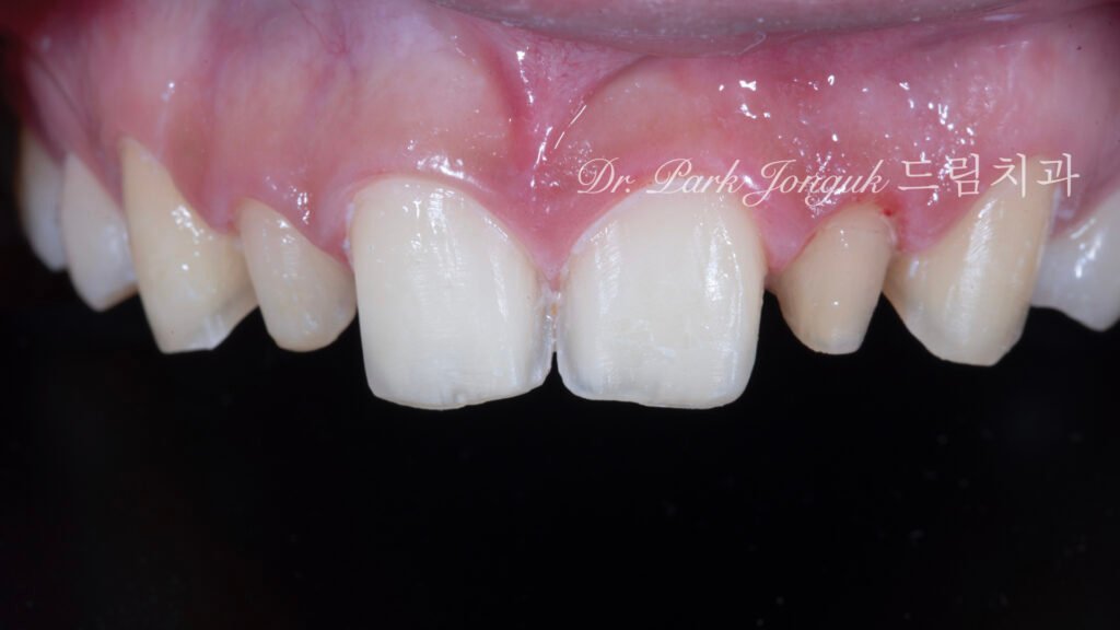 왜소측절치-치아준비-차등삭제