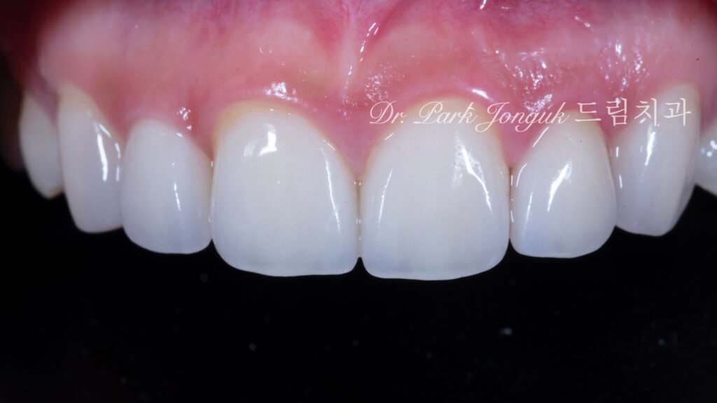 왜소측절치-라미네이트-완성