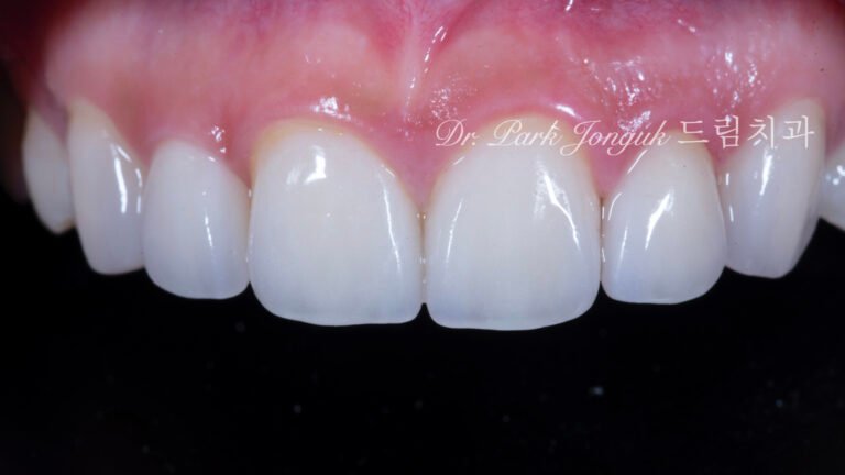 왜소측절치-라미네이트-완성