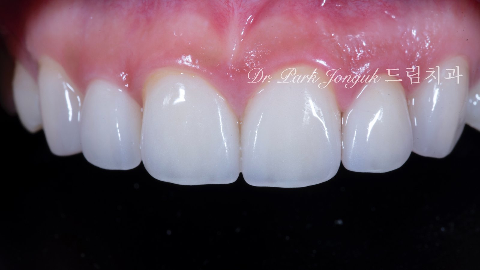 왜소측절치-라미네이트-완성