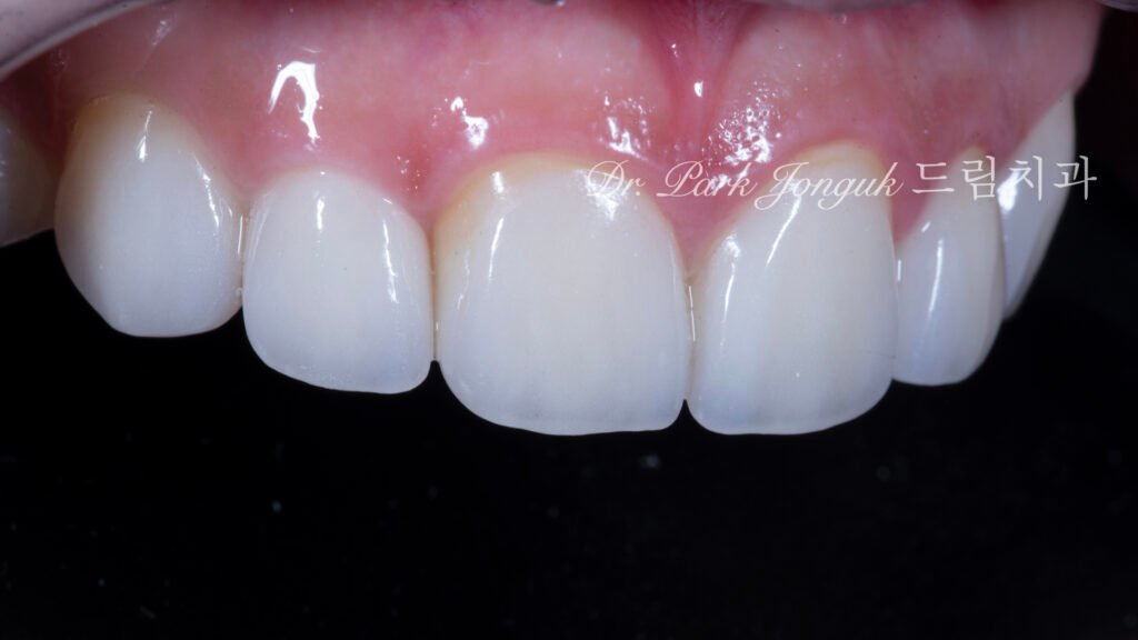 왜소측절치-라미네이트-완성