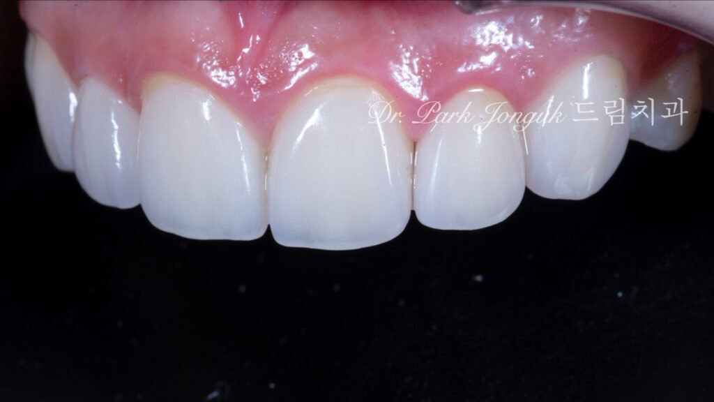 왜소측절치-라미네이트-완성