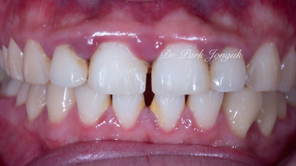 잇몸염증 벌어진치아 라미네이트
