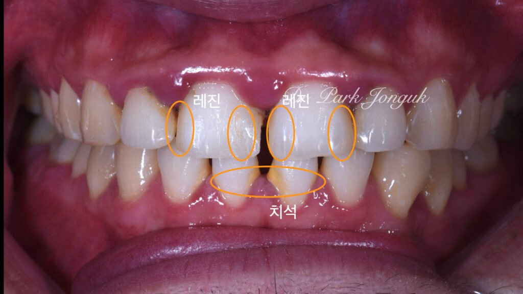 잇몸염증 벌어진치아 라미네이트