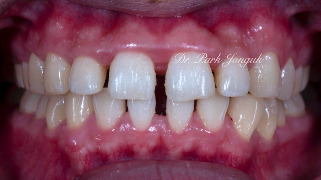 잇몸염증 벌어진치아 라미네이트