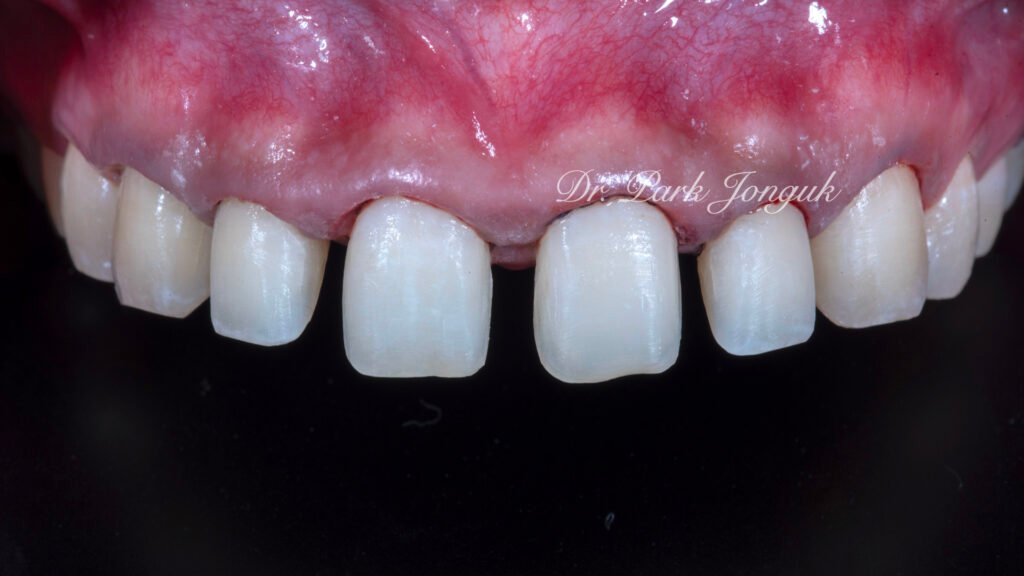 잇몸염증 벌어진치아 라미네이트