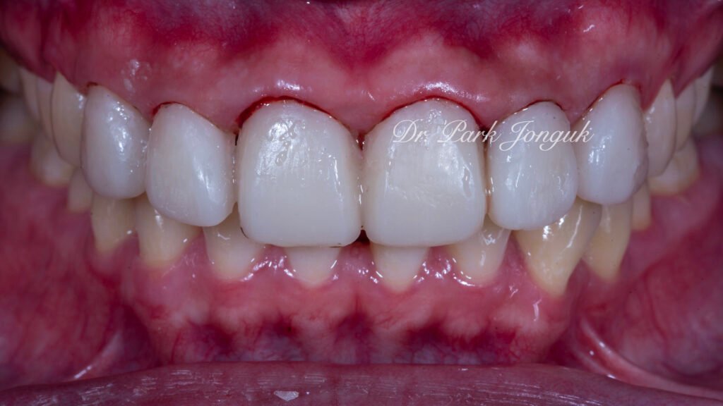 잇몸염증 벌어진치아 라미네이트