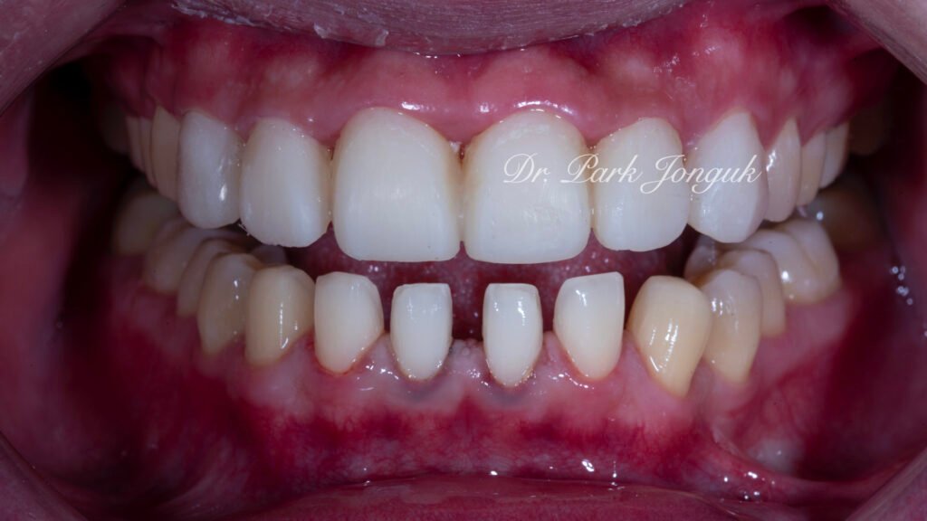 잇몸염증 벌어진치아 라미네이트