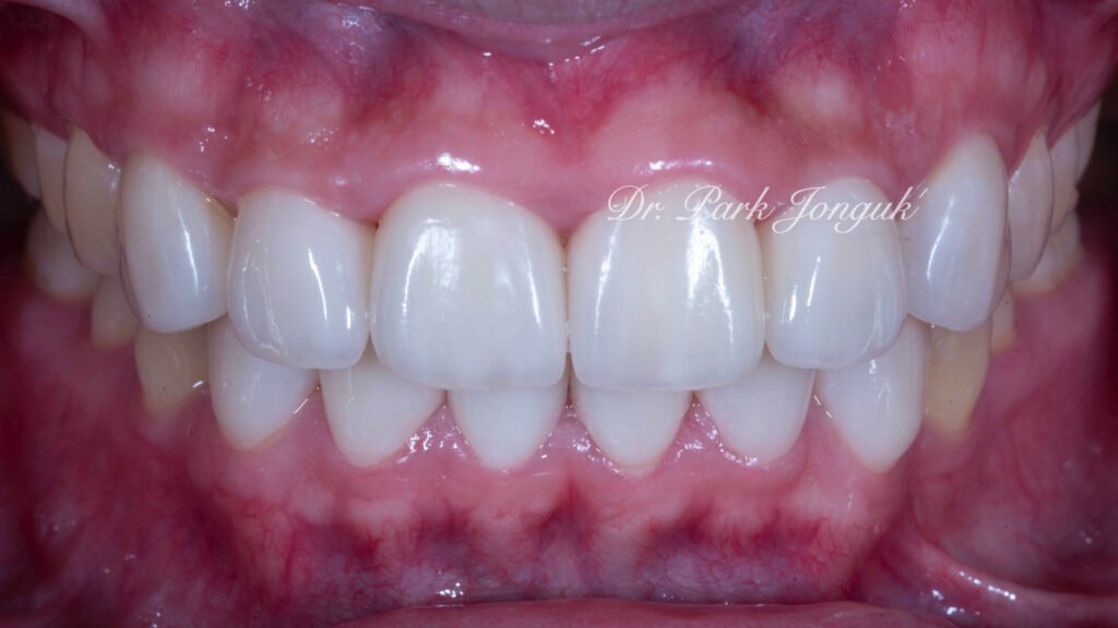 잇몸염증 벌어진치아 라미네이트