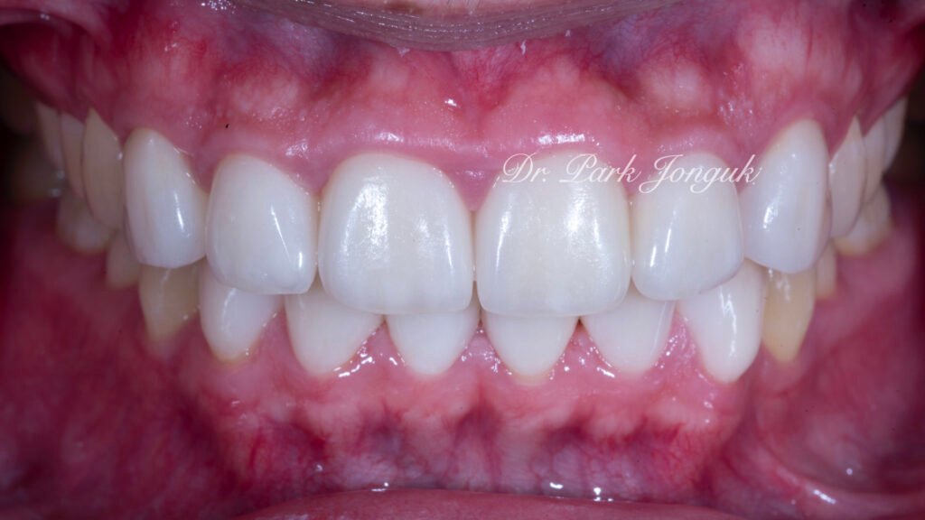 잇몸염증 벌어진치아 라미네이트