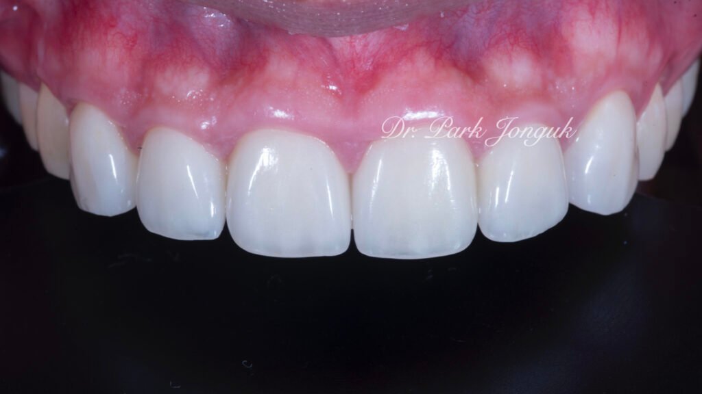 잇몸염증 벌어진치아 라미네이트