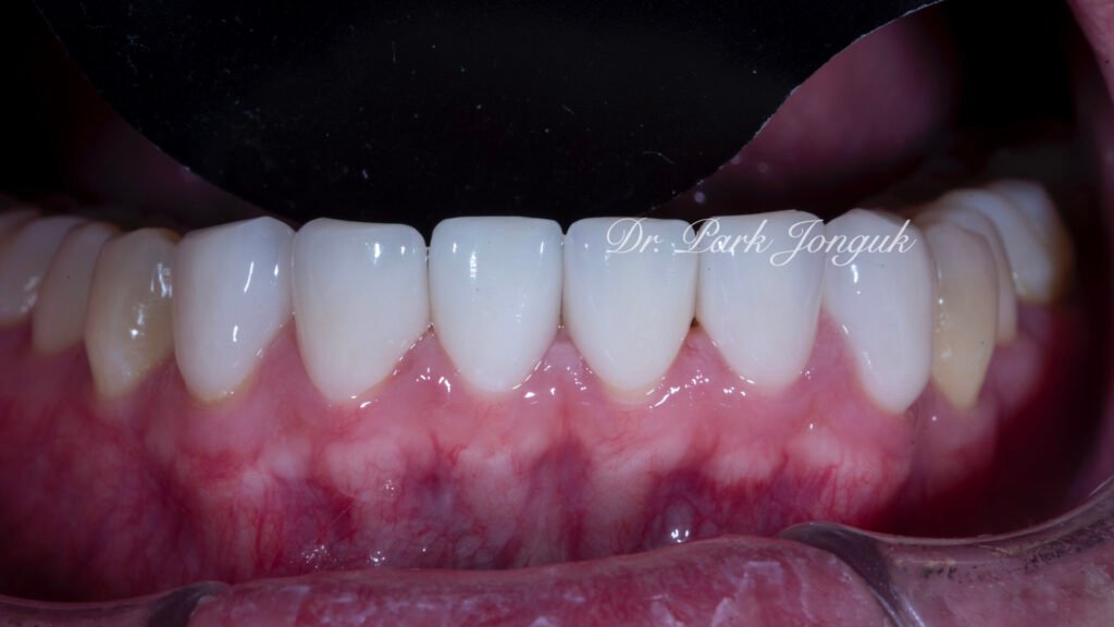 잇몸염증 벌어진치아 라미네이트