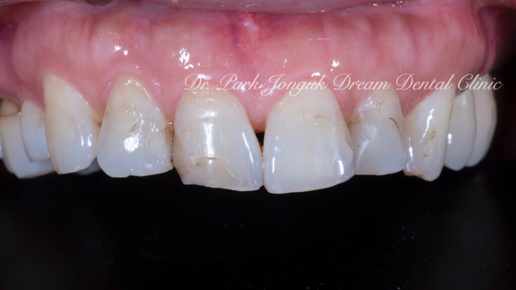 앞니 충치 레진변색 라미네이트
