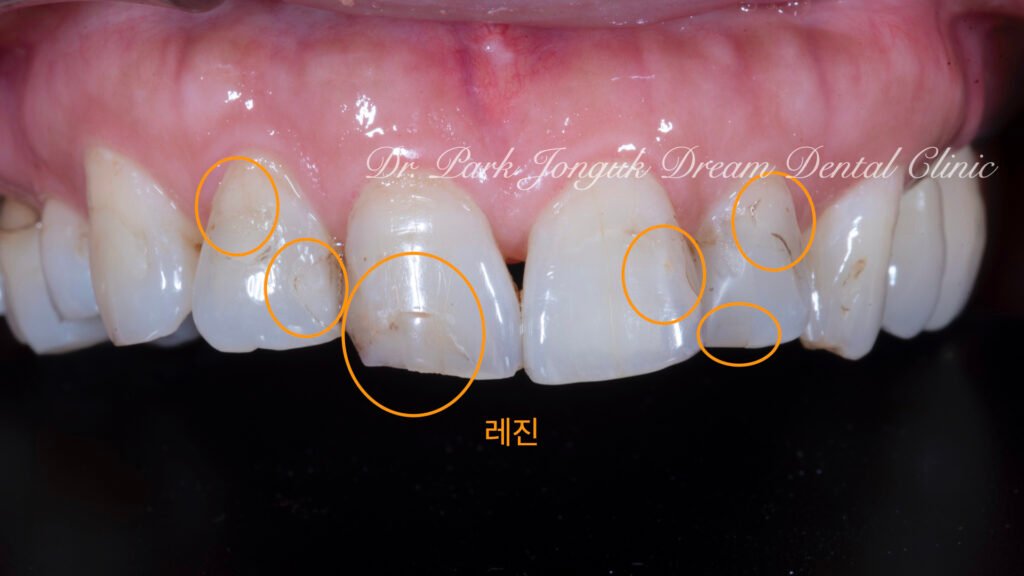 앞니 충치 레진변색 라미네이트