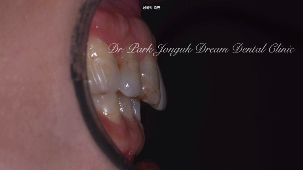 앞니 충치 레진변색 라미네이트