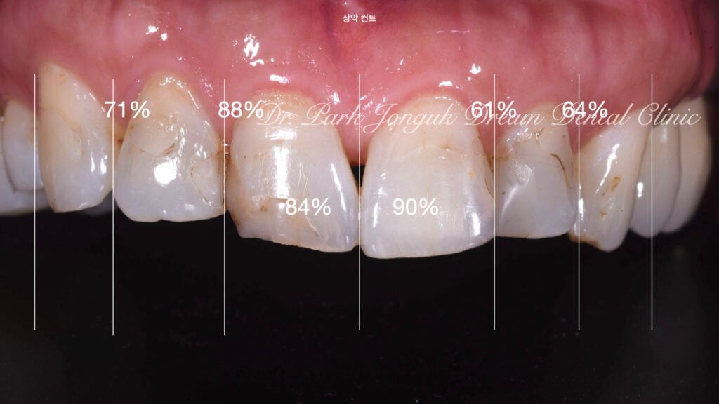 앞니 충치 레진변색 라미네이트