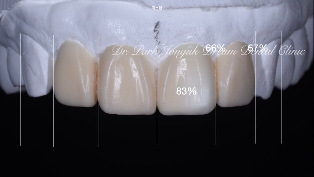 앞니 충치 레진변색 라미네이트