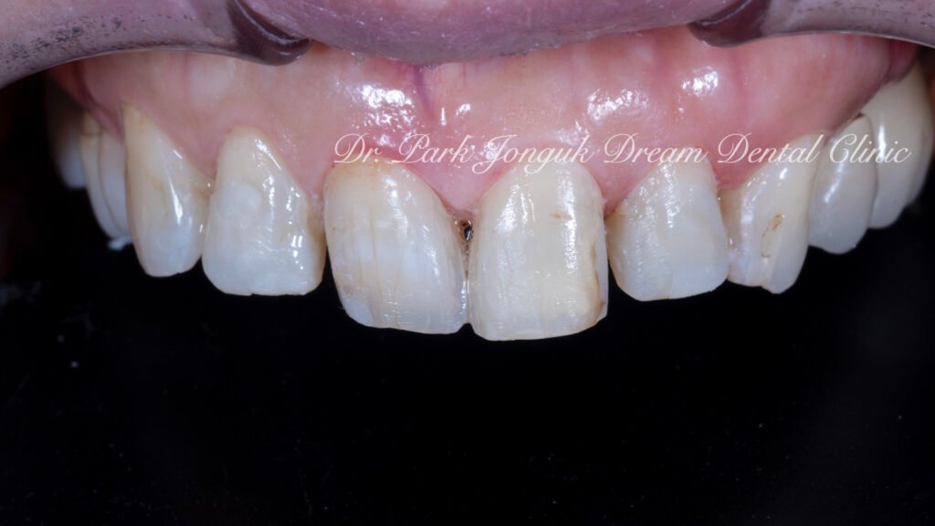 앞니 충치 레진변색 라미네이트