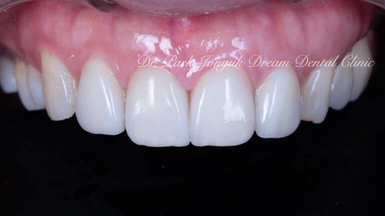 앞니 충치 레진변색 라미네이트