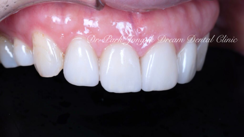 앞니 충치 레진변색 라미네이트