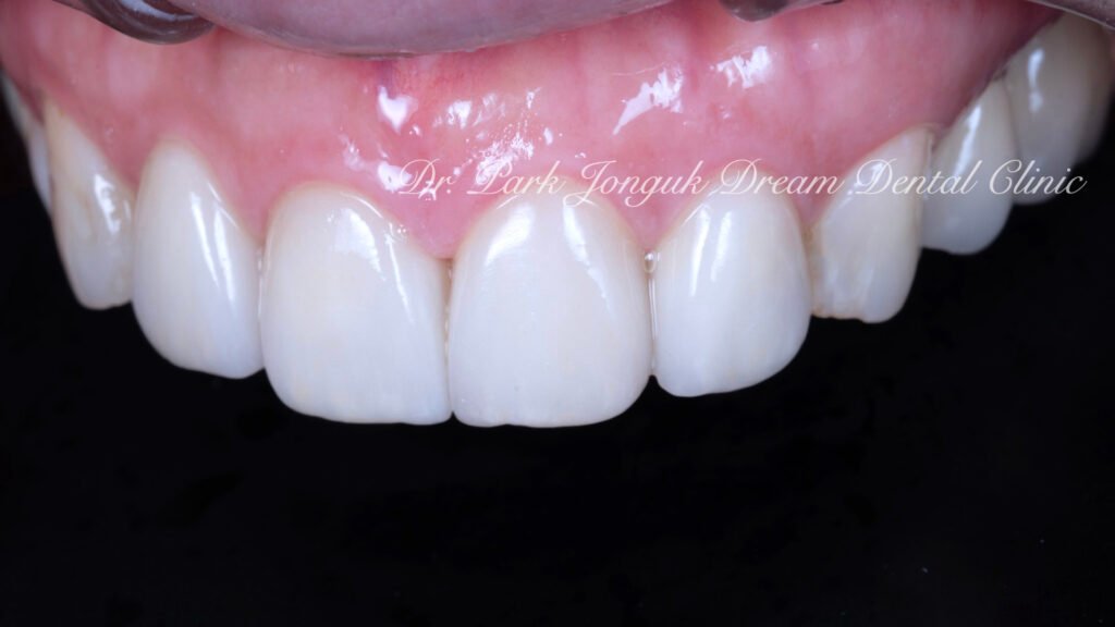 앞니 충치 레진변색 라미네이트