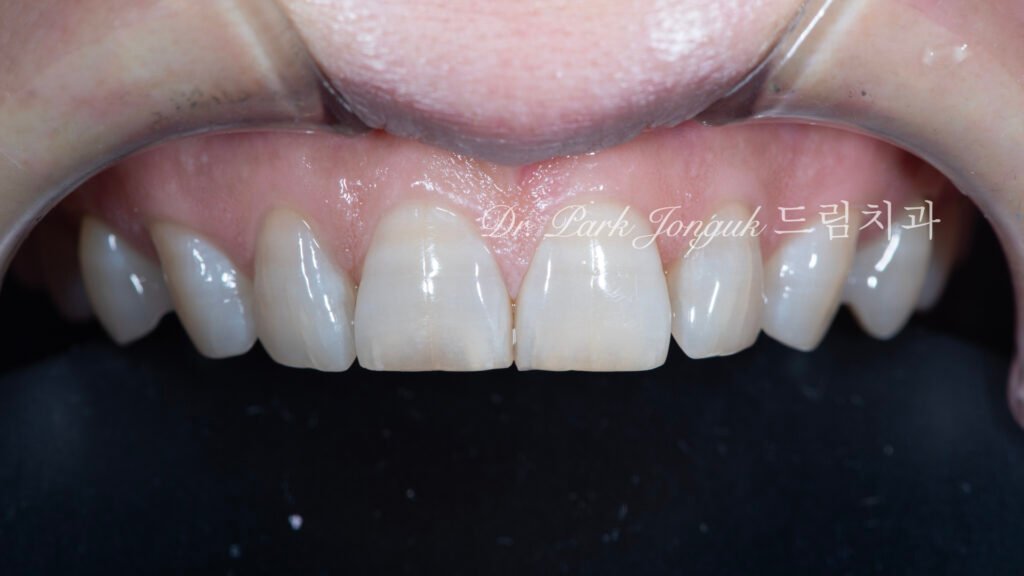 큰앞니-변색치아-치료전-비율불균형