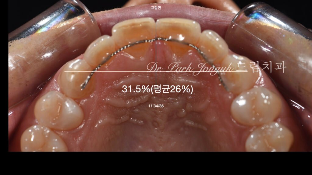 라미네이트-치아비율-측정-진단