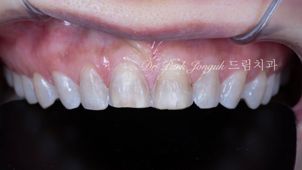 차등삭제-치아준비-최소침습