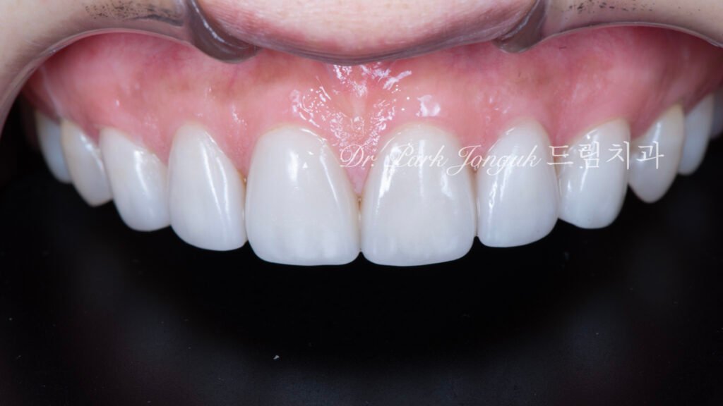 큰앞니-라미네이트-치료후