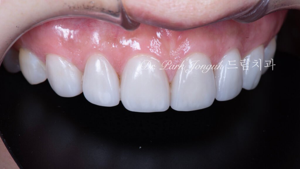 큰앞니-라미네이트-치료후