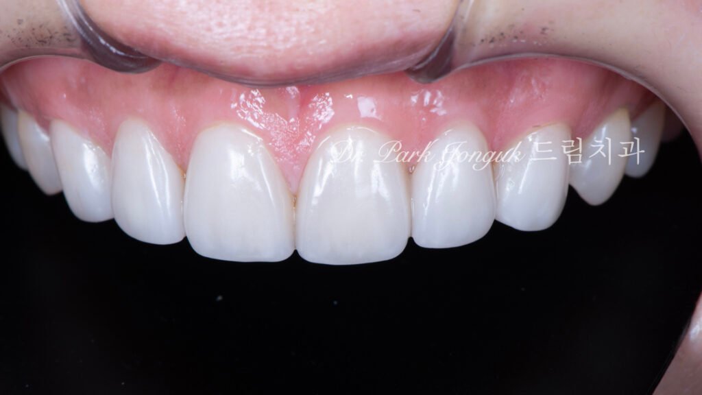 큰앞니-라미네이트-치료후
