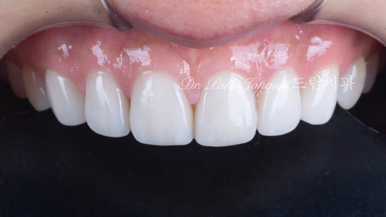 라미네이트-6년추적-장기유지