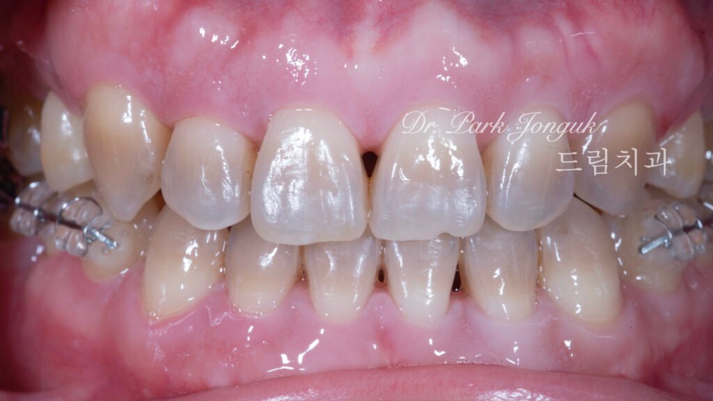 테트라사이클린 변색 라미네이트