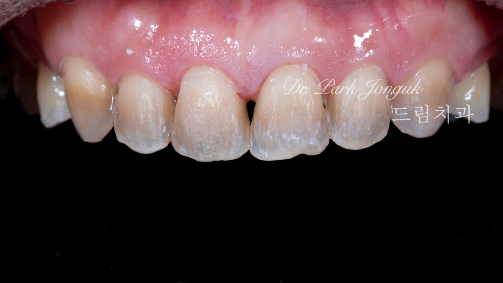 테트라사이클린 변색 라미네이트