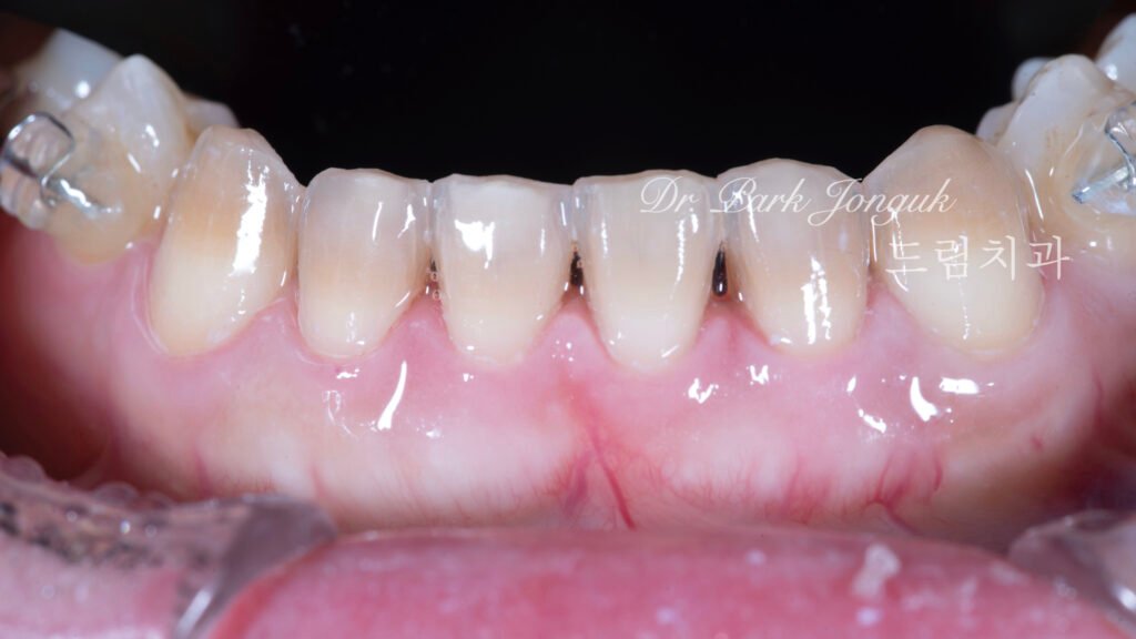 테트라사이클린 변색 라미네이트